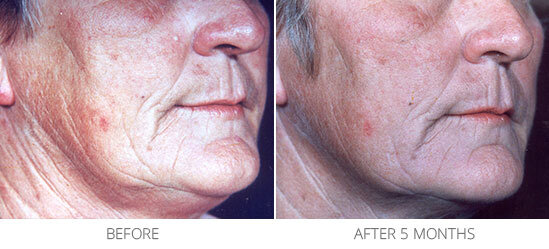 BeforeAfter-CombinationTreatment2-5d51cc21b65f7.jpg