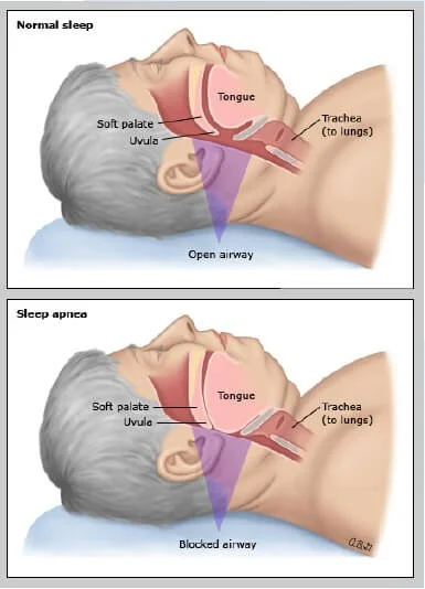 Obstructive Sleep Apnoea (OSA) illustration showing obstructed airway during sleep apnoea versus normal sleep