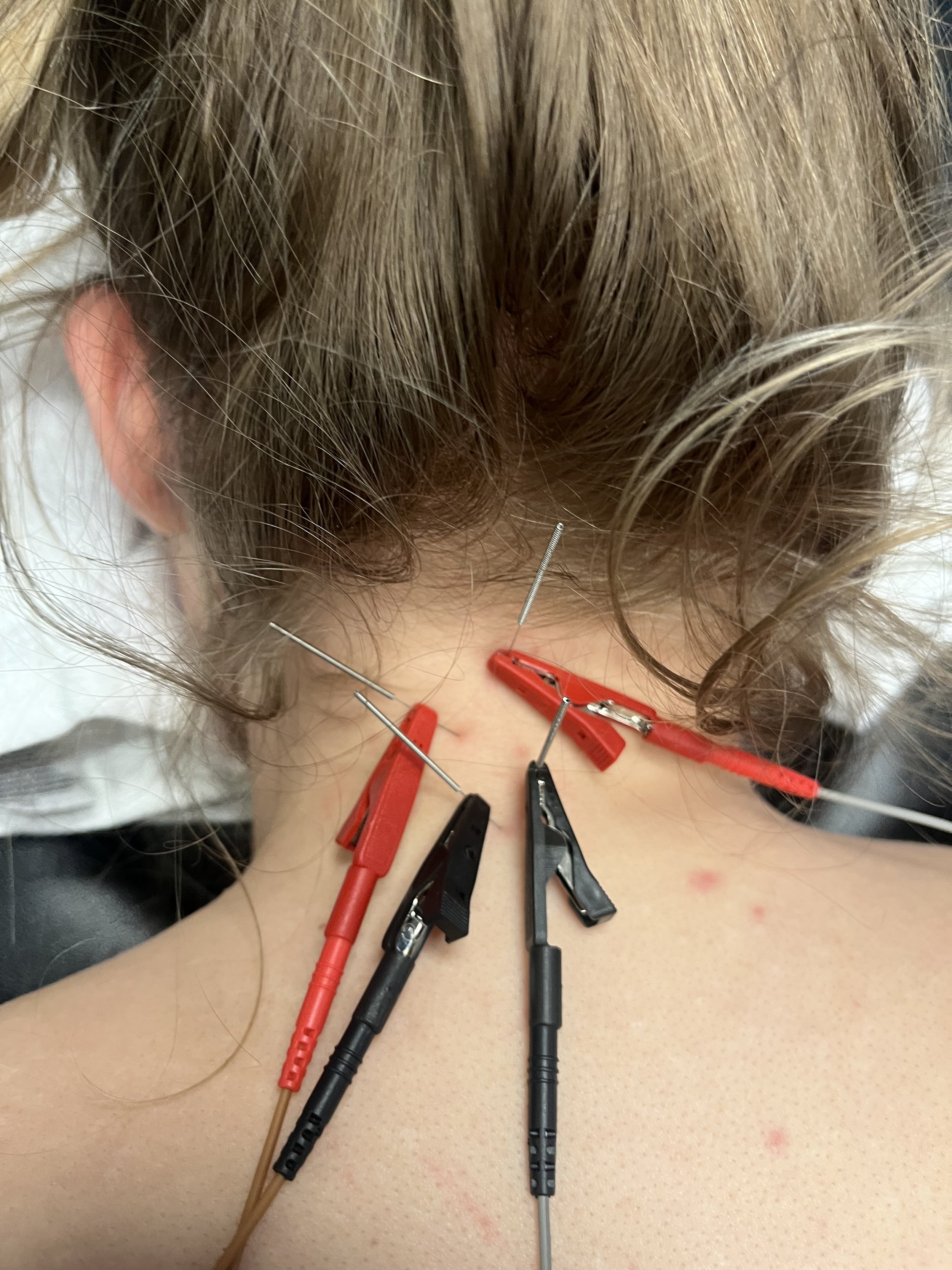 The Ultimate Guide to Dry Needling in South Denver: How It Works, Benefits, and What to Expect