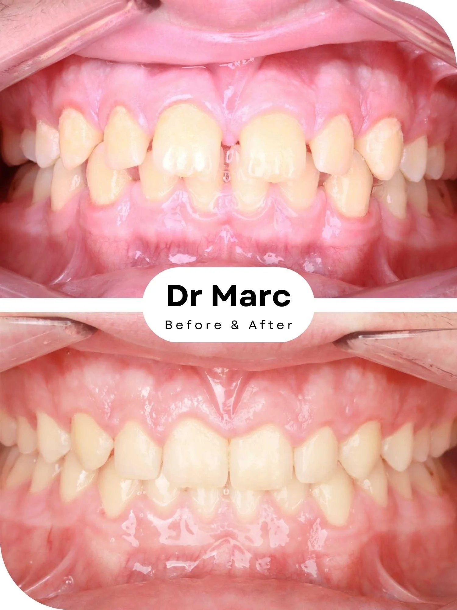 Invisalign Braces Before and After JS.jpg