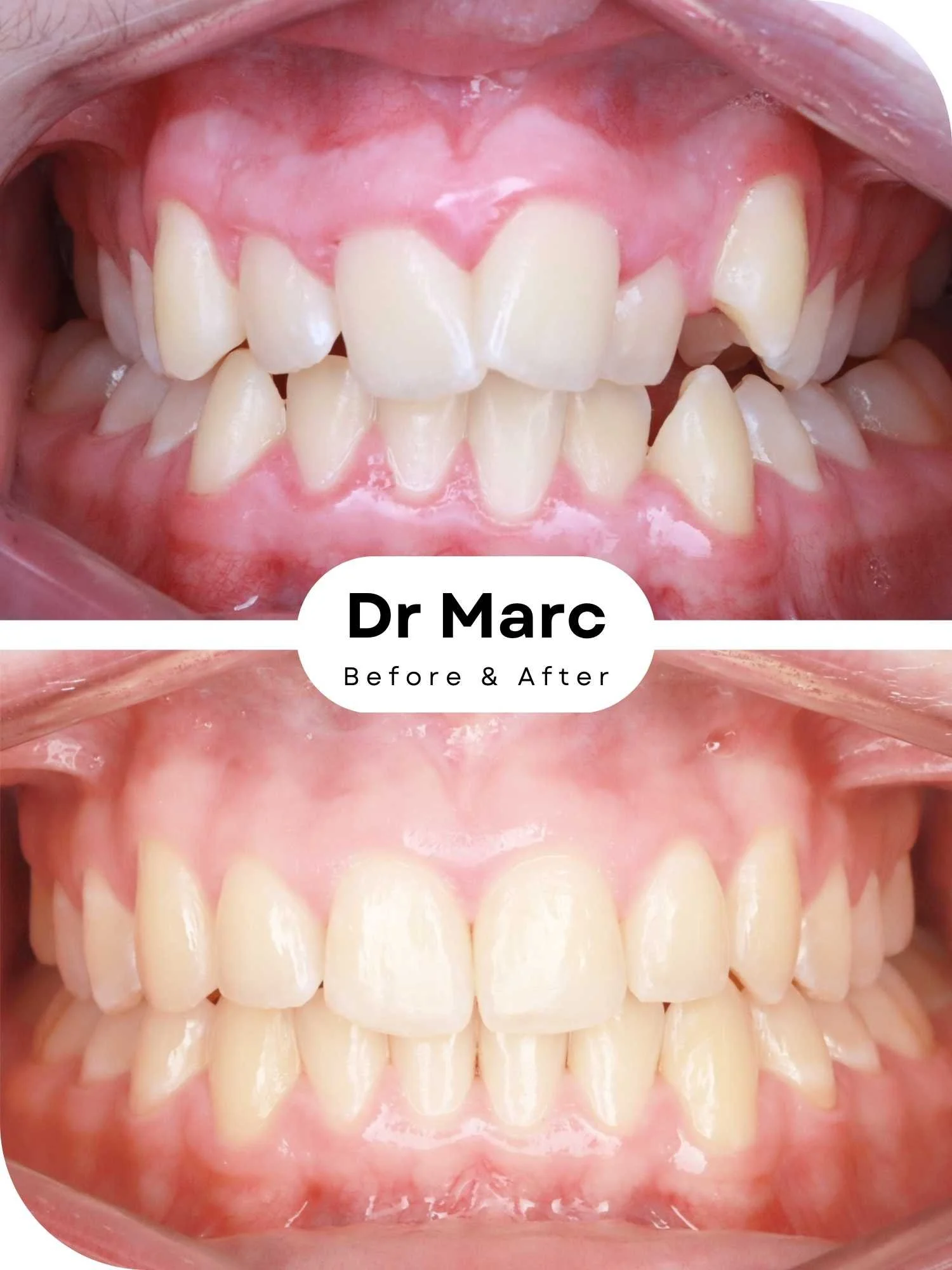 Invisalign Braces Before and After MB.jpg