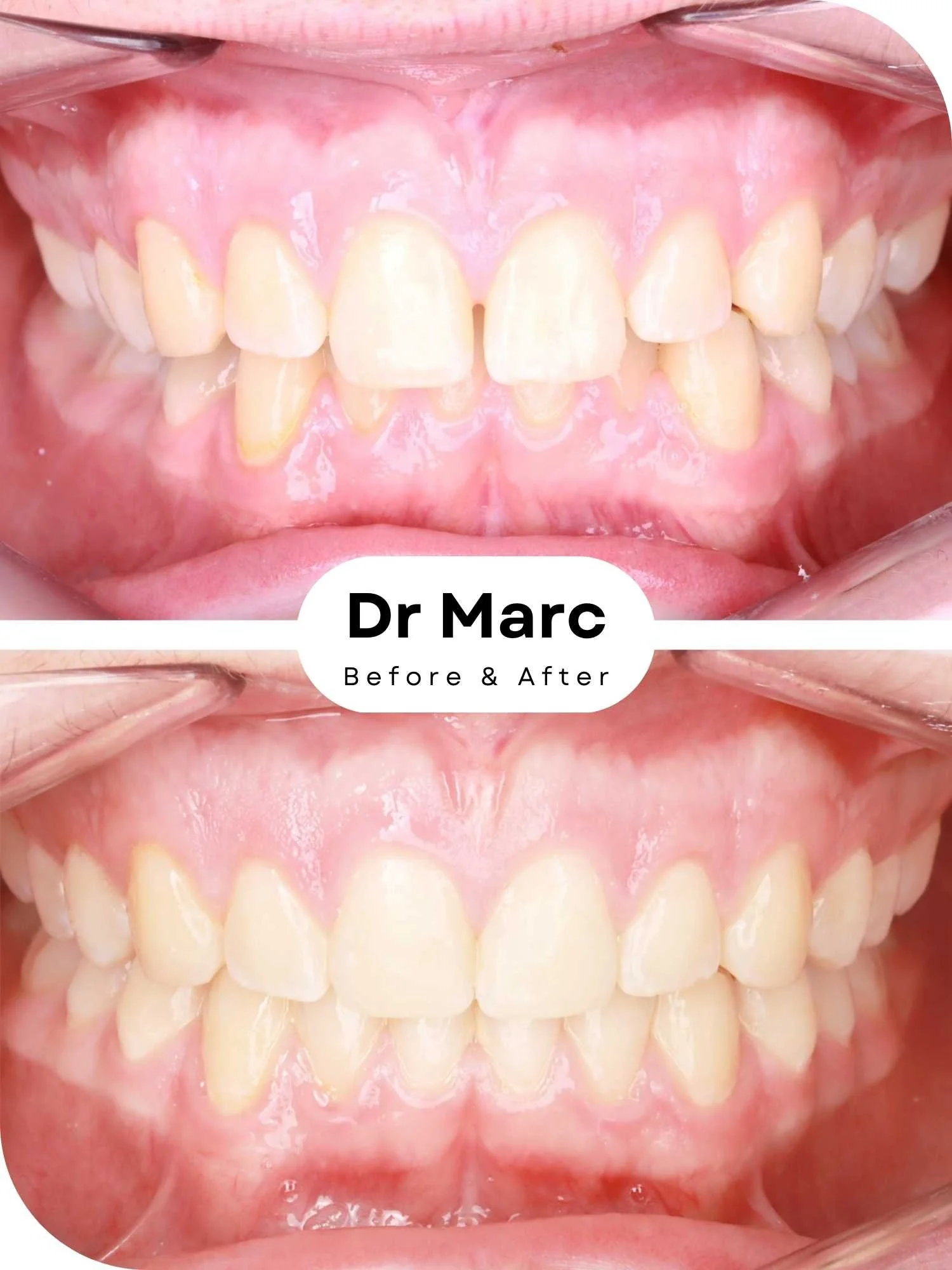 Invisalign Braces Before and After SP.jpg