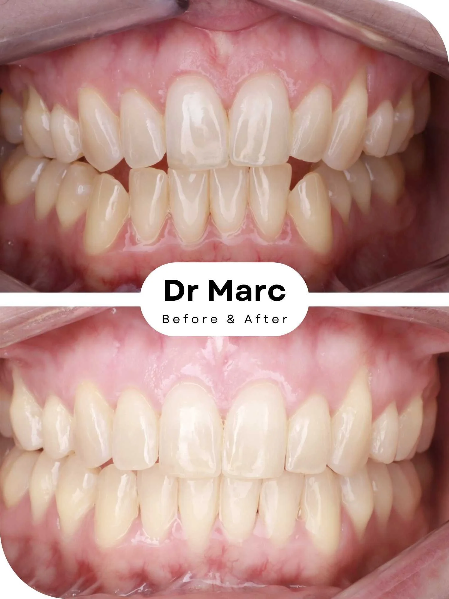 Invisalign Braces Before and After BS.jpg