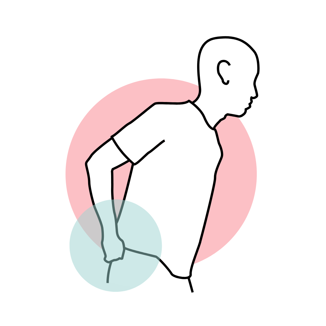 Sciatica