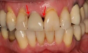 Fixing Black Hole Disease With Dental Crowns