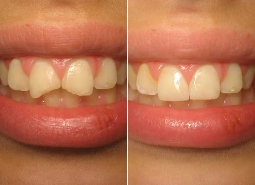 Dental Bonding in Los Angeles by Top Cosmetic Dentist