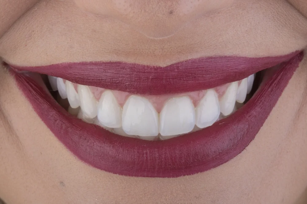 Upper Lip Lift Without Surgery in Los Angeles Glosman LipLift