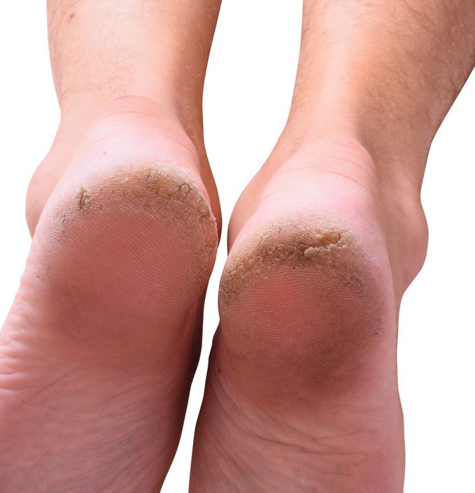 What your FEET say about your health - from cracked heels to bunions | The  US Sun