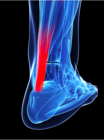 Peroneal Tendonitis: Causes, Symptoms, and Treatment
