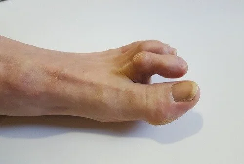 Preventing and Treating Corns and Calluses