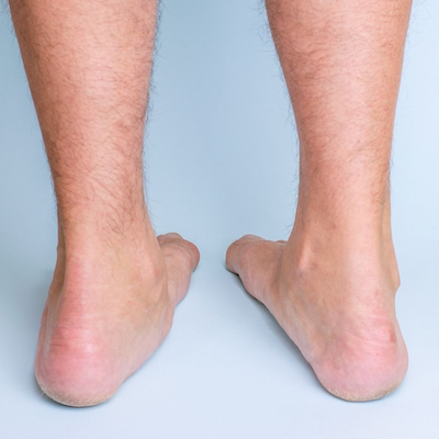 Flat Feet: Causes, Symptoms, and Treatment