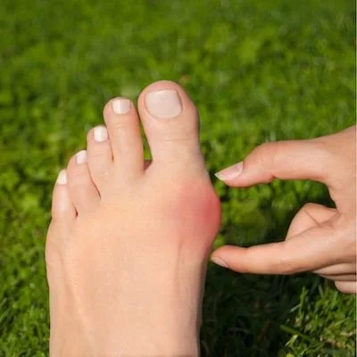 Pain Relief from Bunions
