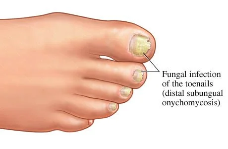 Common Toenail Conditions