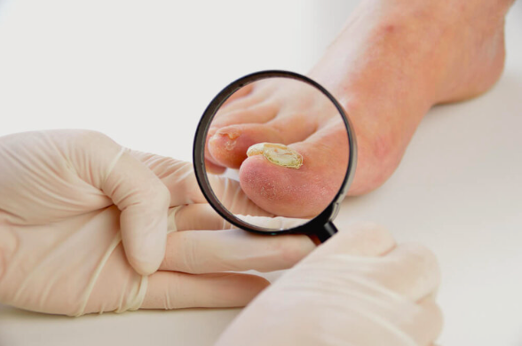 Fungal Toenail Infections – Identifying, Prevention and Treatment