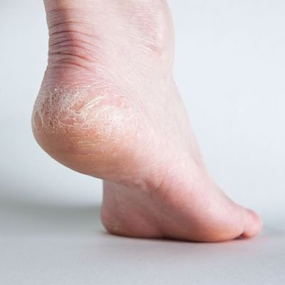 Well-Heeled: How to Treat Cracked Heels