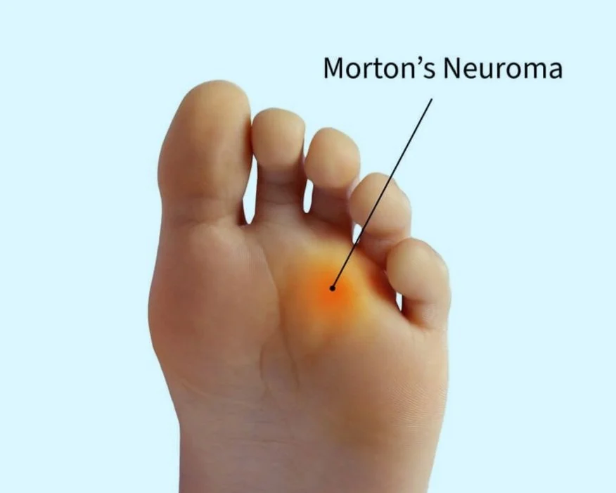 Nerve Related Foot Care, Neuropathy, Neuromas| Hamilton Twp, NJ Foot ...