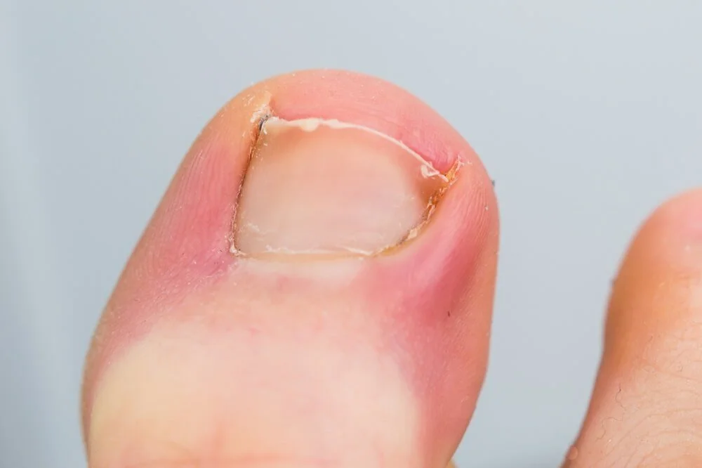 Ingrown & Unsightly Toenails - Hamilton Twp, NJ Podiatrist — Dr. James  Ricketti & Associates