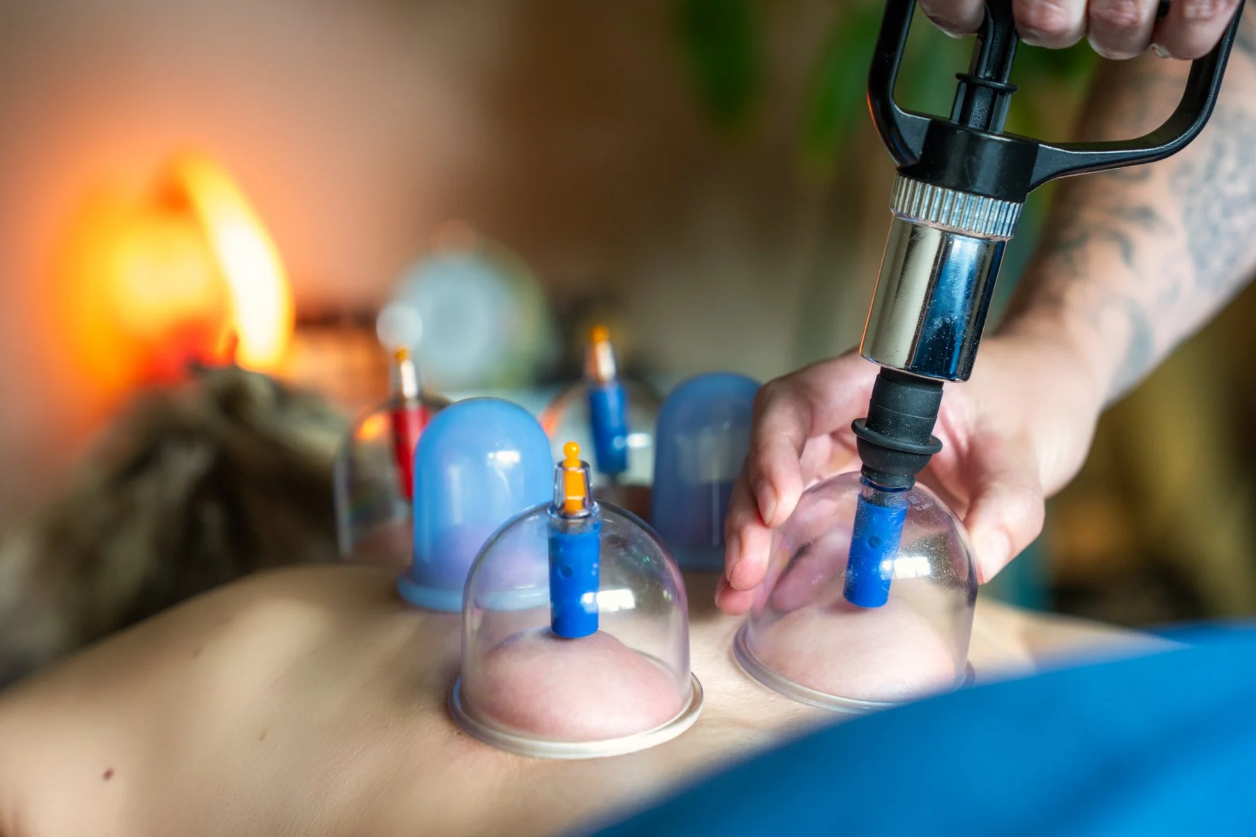Person receiving cupping therapy with multiple glass cups on their back, while a practitioner uses a pump to create suction.