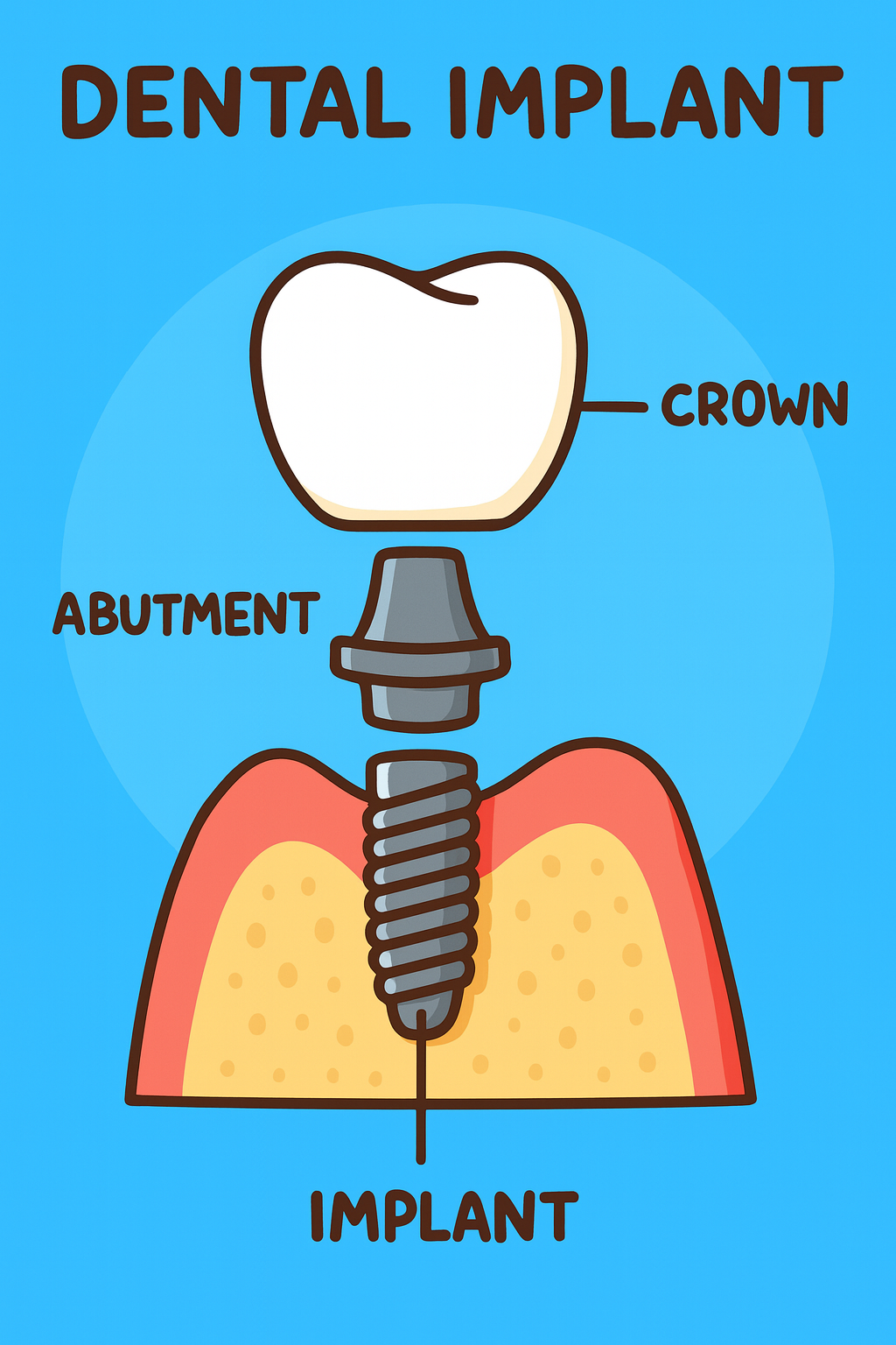 Dental Implant Diagram.png