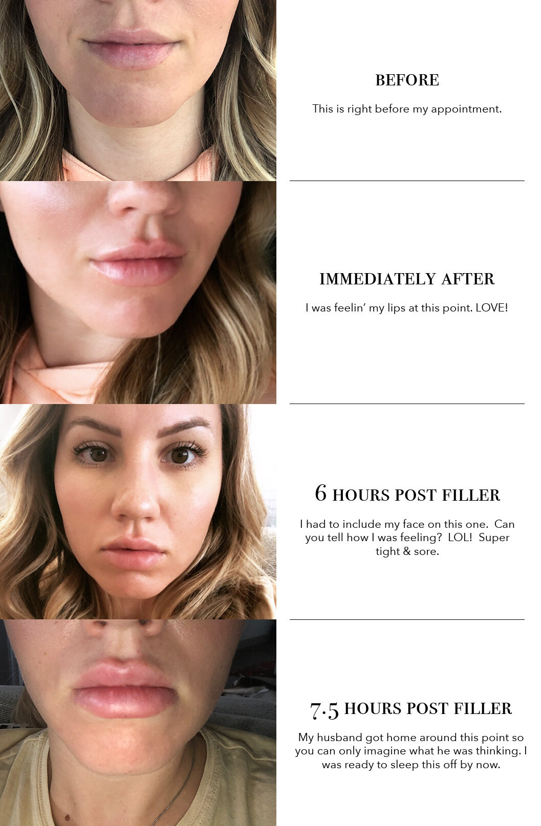 My Experience with Lip Fillers + All the Details — That Boujee Bohemian |  Travel & Lifestyle Blog