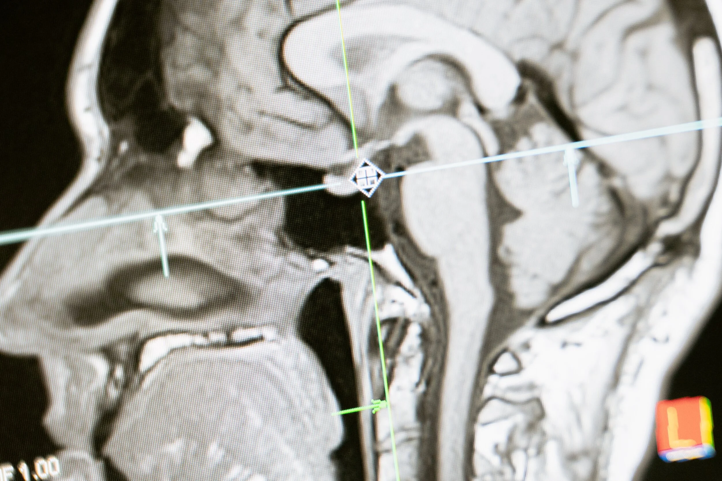 Concussion and Traumatic Brain Injury