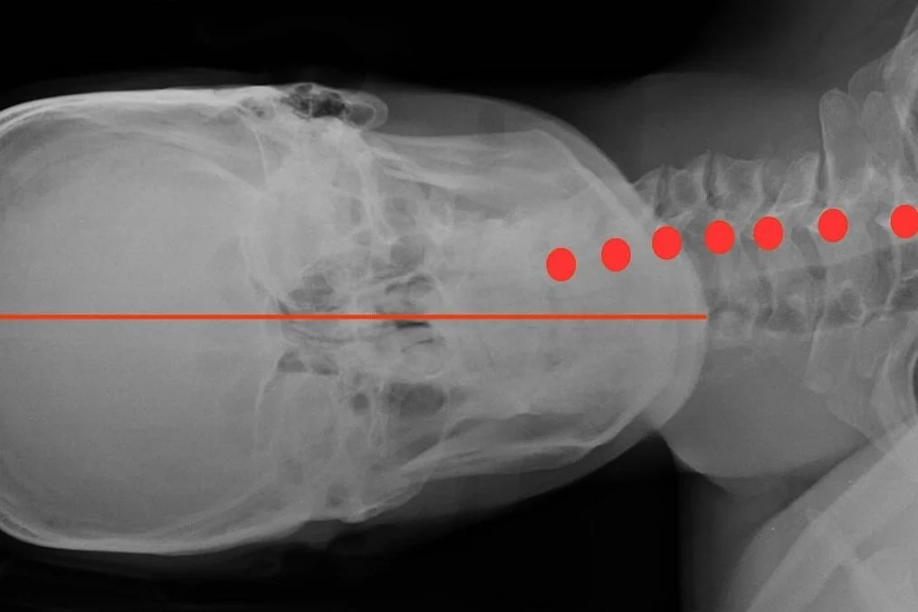 Side sleeper, pillow too low; this position places load onto the shoulder and the joints on the downward facing side, and also potentially impinges nerves that go down the arm.