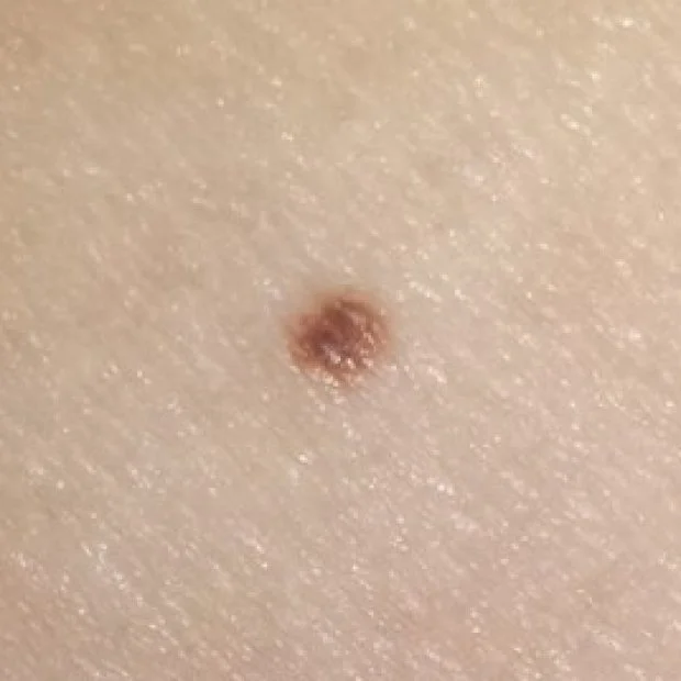 common-skin-mole.jpg