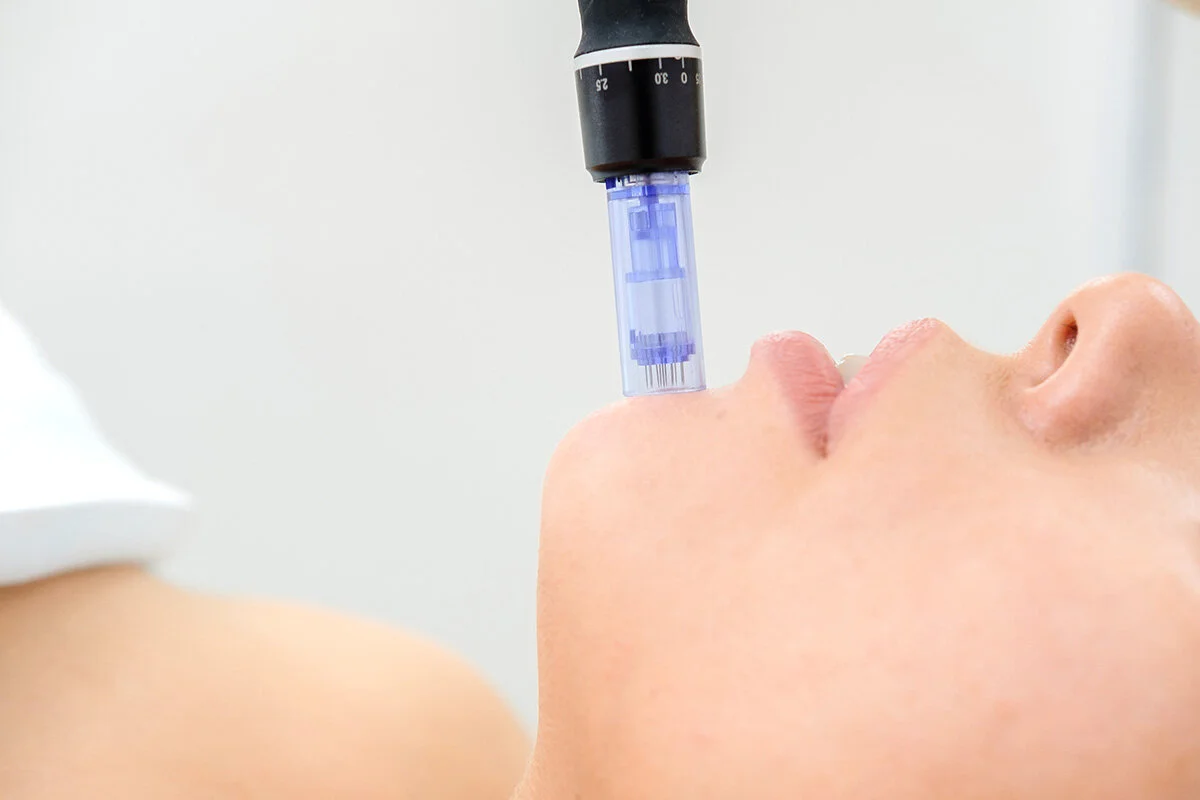 Close up of microneedling treatment on a woman's chin