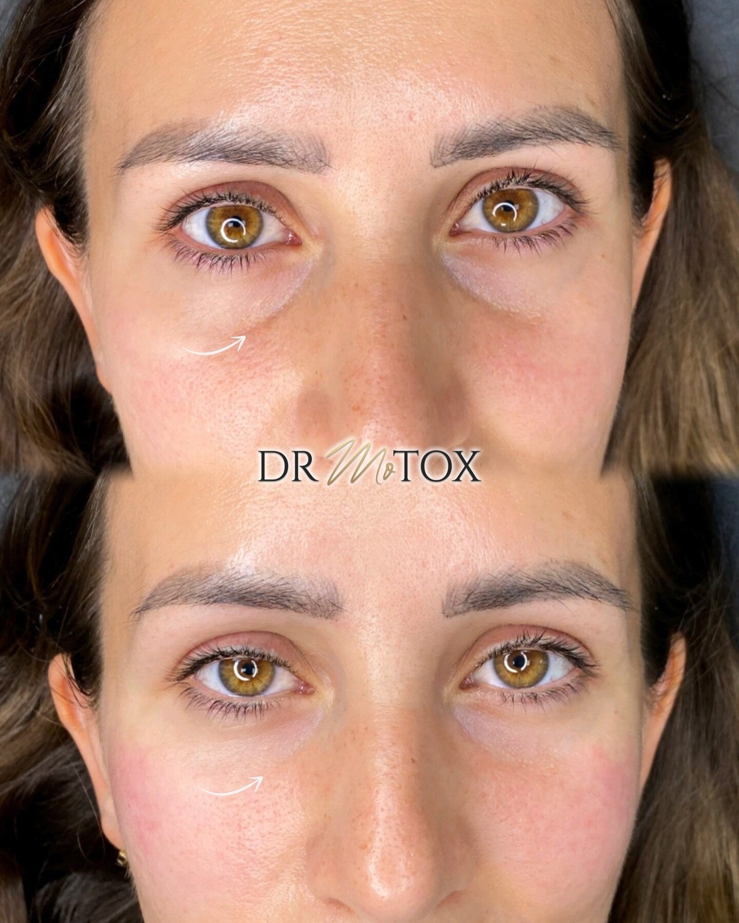 ✨𝐔𝐧𝐝𝐞𝐫-𝐞𝐲𝐞 𝐅𝐢𝐥𝐥𝐞𝐫 𝐢𝐬 𝐚 𝐟𝐨𝐫𝐦 𝐨𝐟 𝐬𝐞𝐥𝐟 𝐜𝐚𝐫𝐞✨⁣ correcting hollowness with filler under the eyes (tear trough) can help give you a more well-rested &amp; fresher appearance! ⁣
⁣⁣
Filler is placed carefully &amp; precisely un