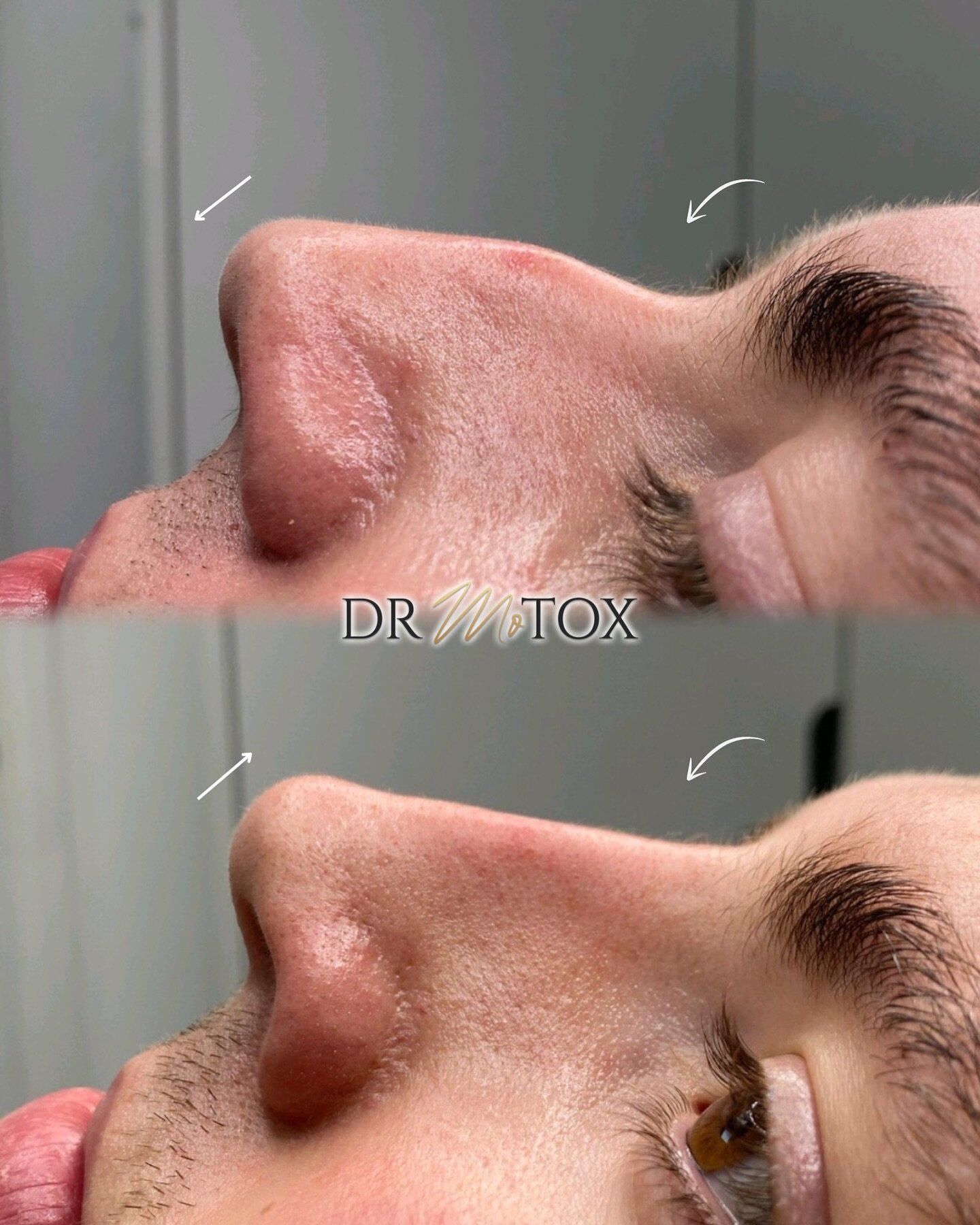 𝐍𝐞𝐰 𝐲𝐞𝐚𝐫, 𝐧𝐞𝐰 𝐧𝐨𝐬𝐞💁🏼&zwj;♀️ If you&rsquo;ve been thinking about booking a Non Surgical Nose Job then 2024 is the year to do it! ⁣
⁣⁣⁣
𝘚𝘢𝘮𝘦 𝘥𝘢𝘺 𝘳𝘦𝘴𝘶𝘭𝘵𝘴, 𝘯𝘰 𝘥𝘰𝘸𝘯𝘵𝘪𝘮𝘦 &amp; 𝘱𝘢𝘪𝘯 𝘧𝘳𝘦𝘦!⁣⁣⁣
⁣⁣⁣⁣⁣⁣⁣⁣
𝘙𝘦𝘴𝘶?