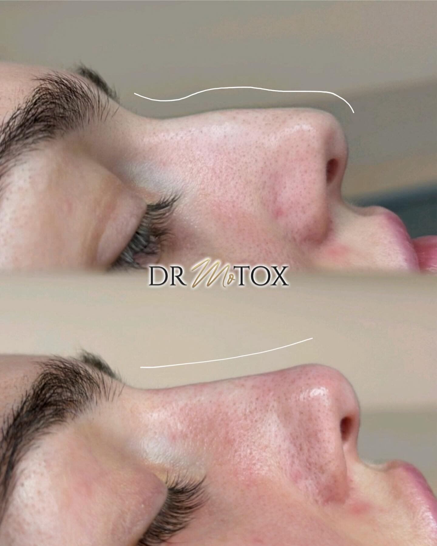✨𝐀 𝐃𝐫 𝐌𝐨𝐭𝐨𝐱 𝐍𝐨𝐬𝐞✨ Our famous Non-Surgical Rhinoplasty results are achieved by Dr Mo&rsquo;s unique approach &amp; techniques, giving amazing natural results like this! Have you booked in for your appointment? Your nose transformation awai