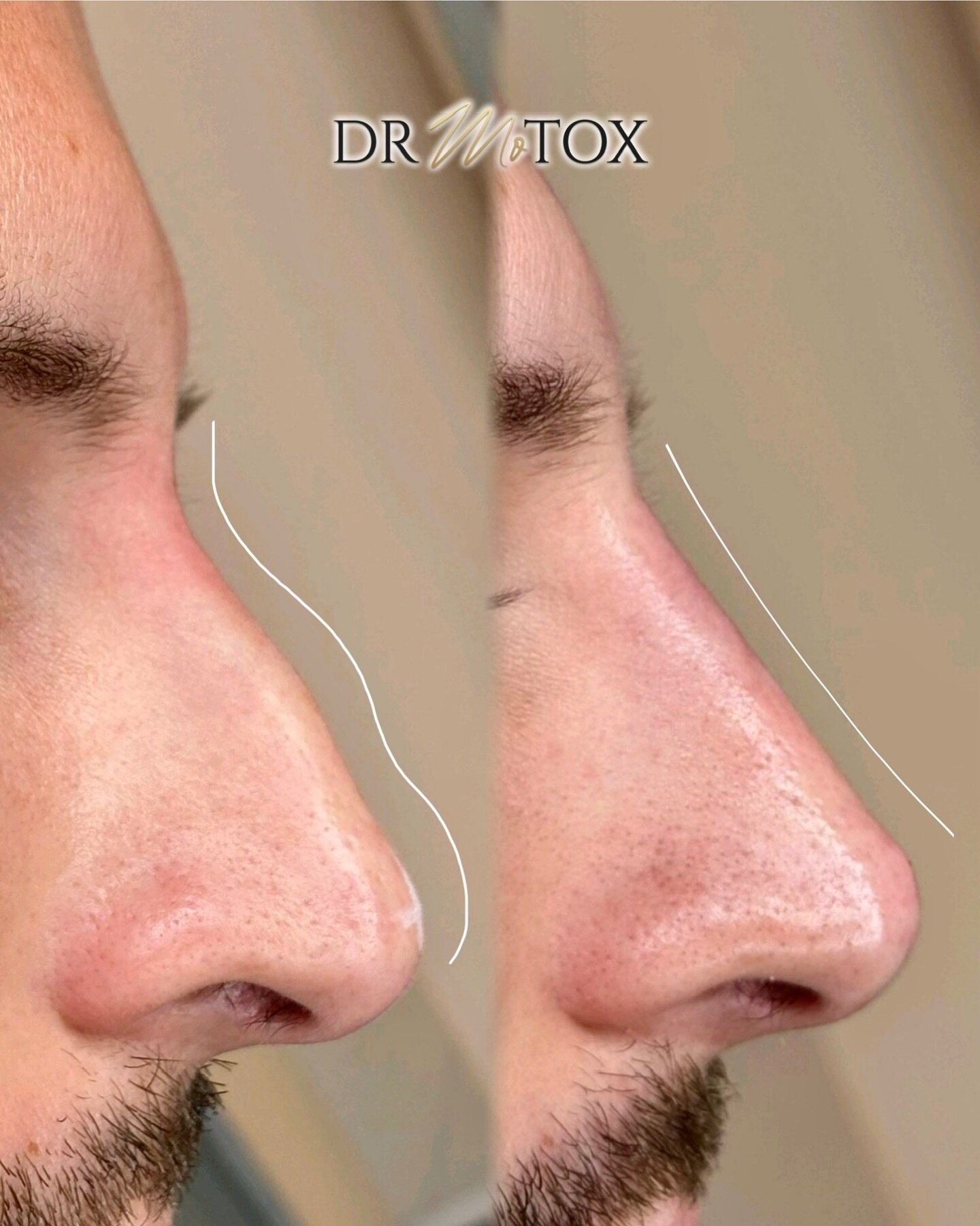 𝐁𝐮𝐦𝐩 𝐟𝐫𝐞𝐞 &amp; 𝐋𝐢𝐟𝐭𝐞𝐝🙌🏼👃🏼 NO surgery required, our Non-Surgical Rhinoplasty uses dermal filler strategically placed in the nose using a needle to mimic bone structure &amp; correct bumps, humps, droopy tips and much more. ⁣
⁣⁣⁣⁣
𝘚