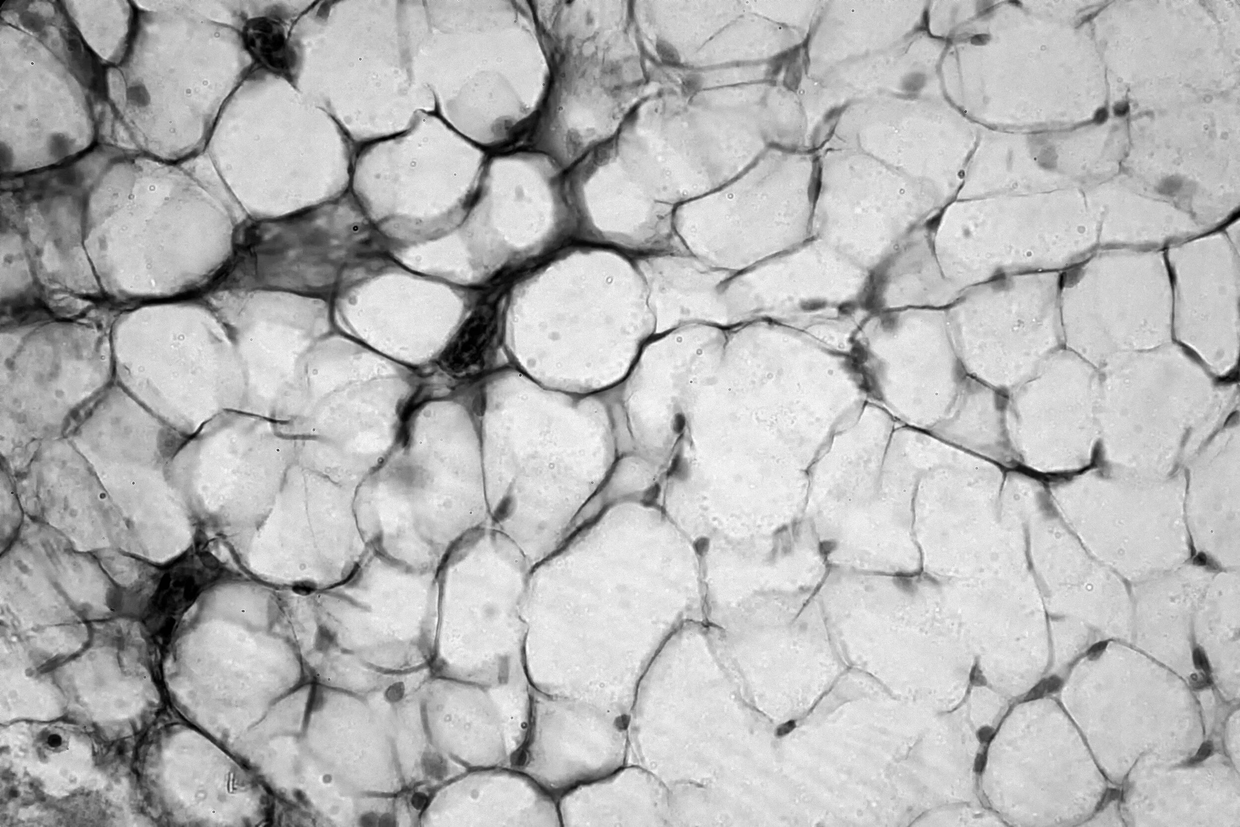 Understanding the Complexities of Cellulite