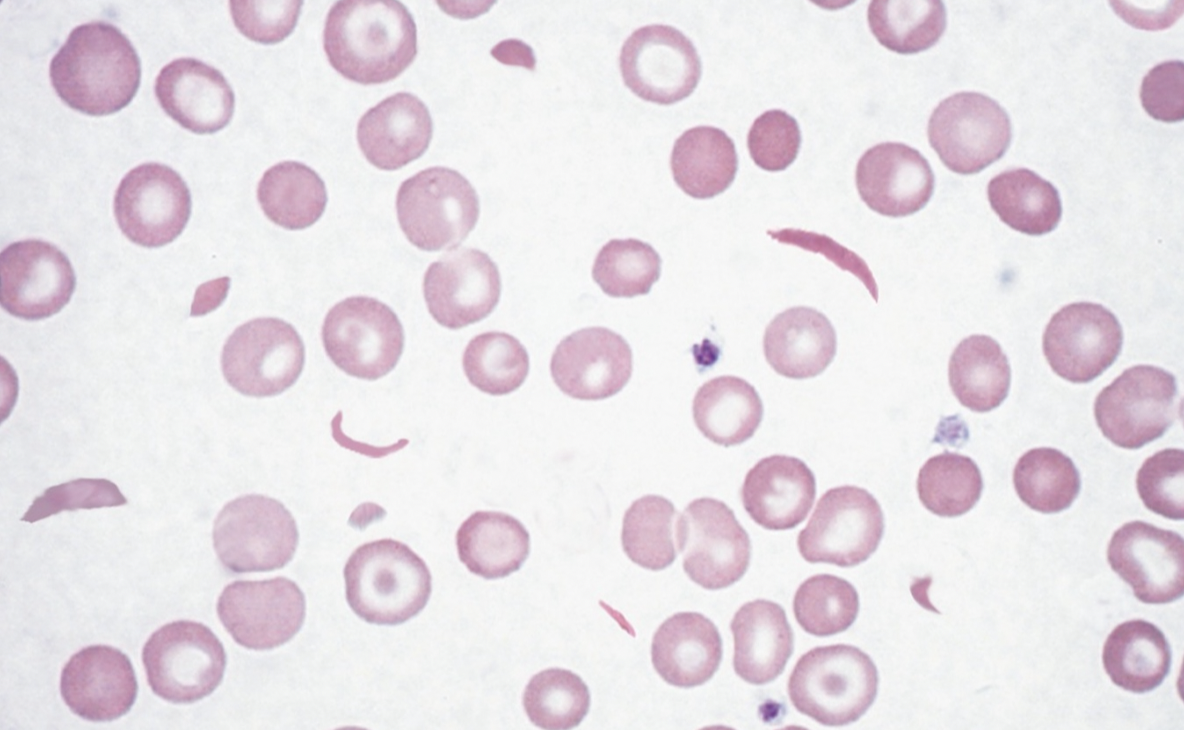 The History and Reality of Living with Sickle Cell Anaemia, with ChiyènneAdrien