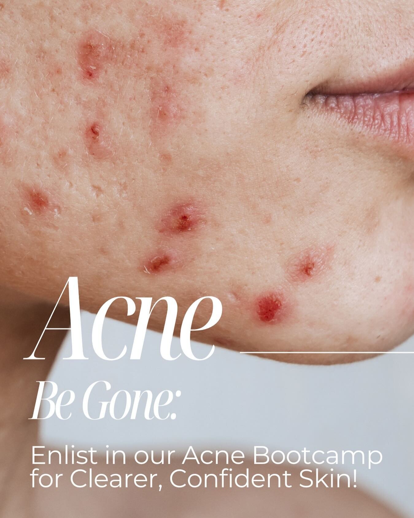 ✨ Acne, be gone! 🚫 Say goodbye to breakouts and hello to radiant skin by summer! ☀️✨ 

Book your spot in our Acne Bootcamp now and let us transform your skin. No more need for makeup &ndash; just natural beauty shining through! 💖💪 

Leave a commen