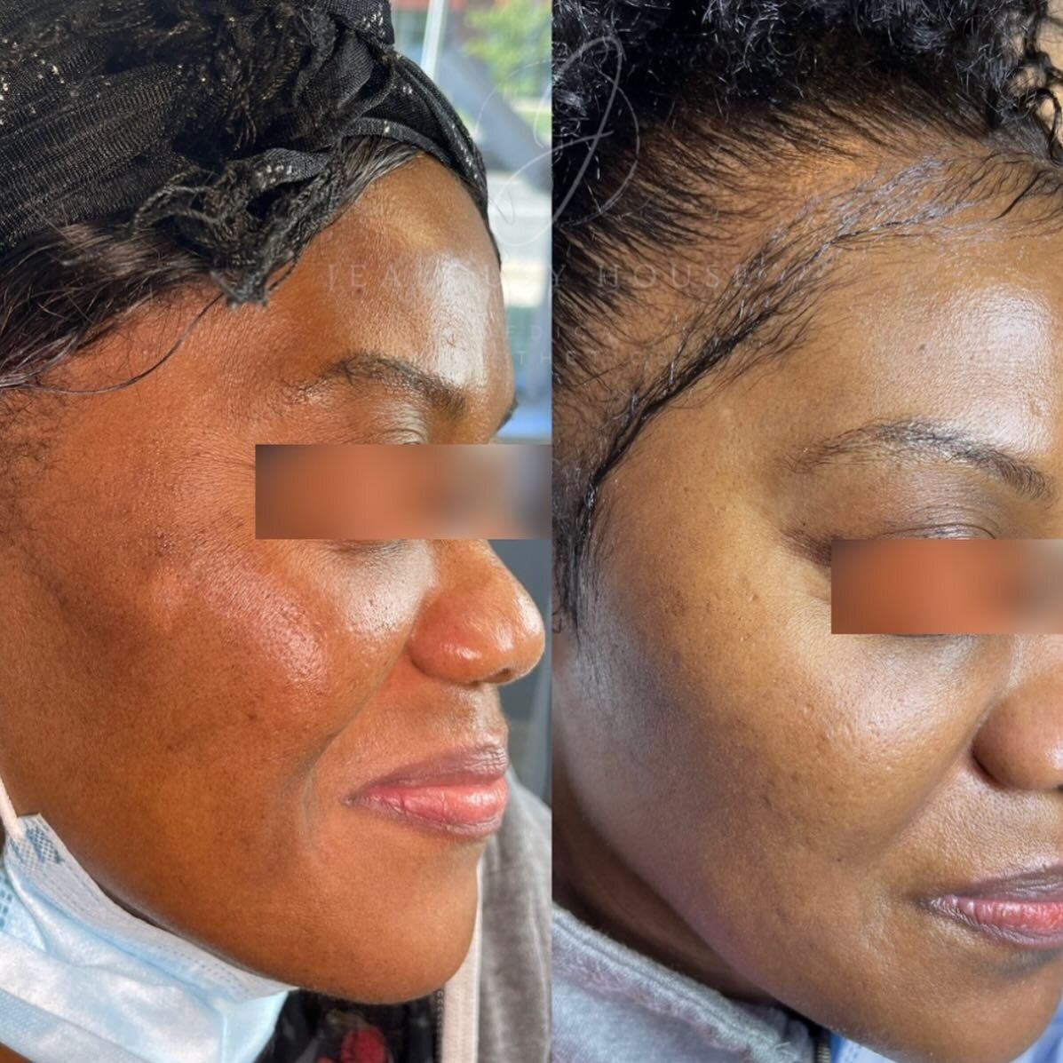 ✨ Say hello to flawless skin with Microneedling! ✨

Struggling with hyperpigmentation and discoloration? Say no more! Our Microneedling treatments are not only safe for dark skin when treated properly but also deliver incredible results! 🙌🏾 Say goo