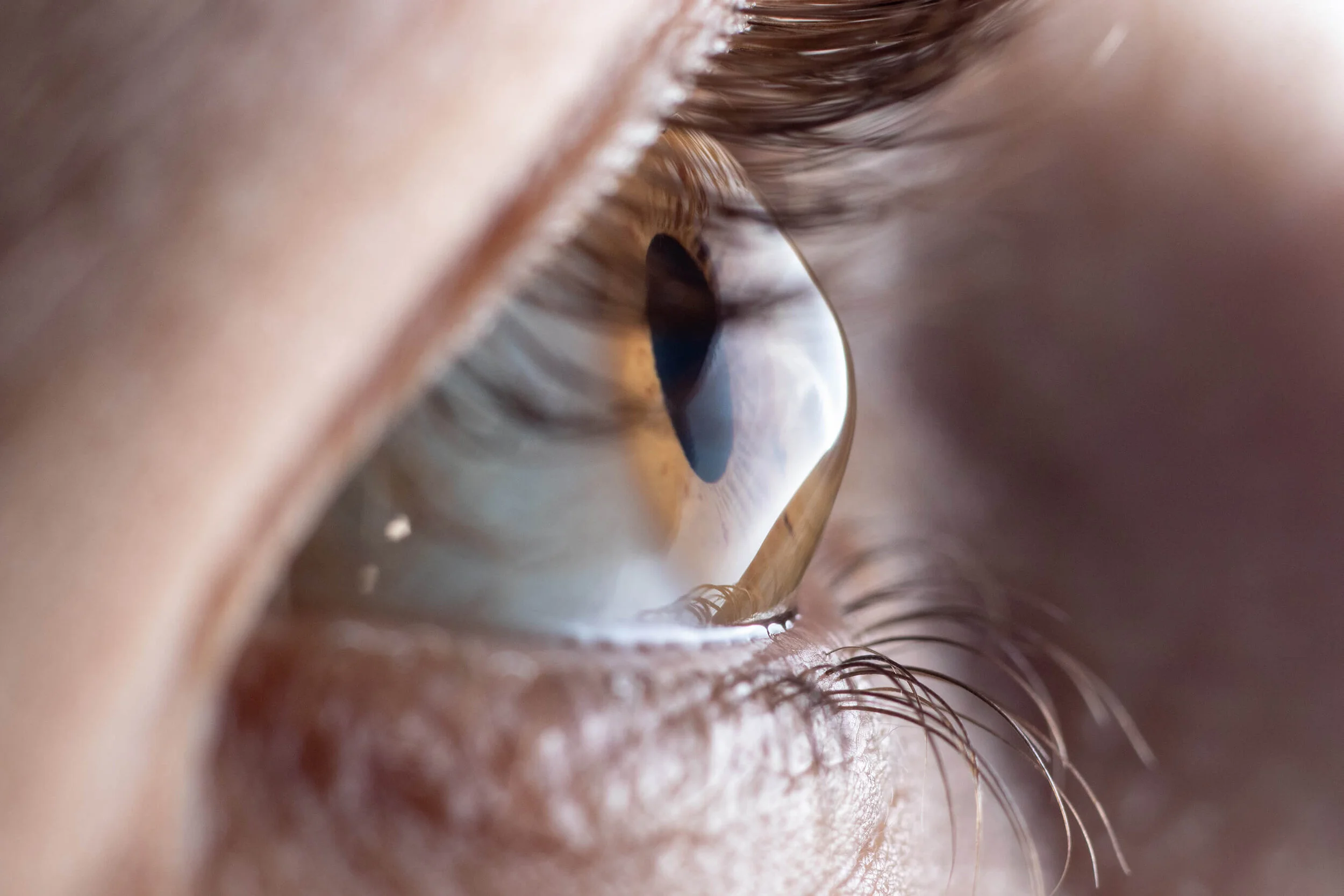 Keratoconus.jpeg