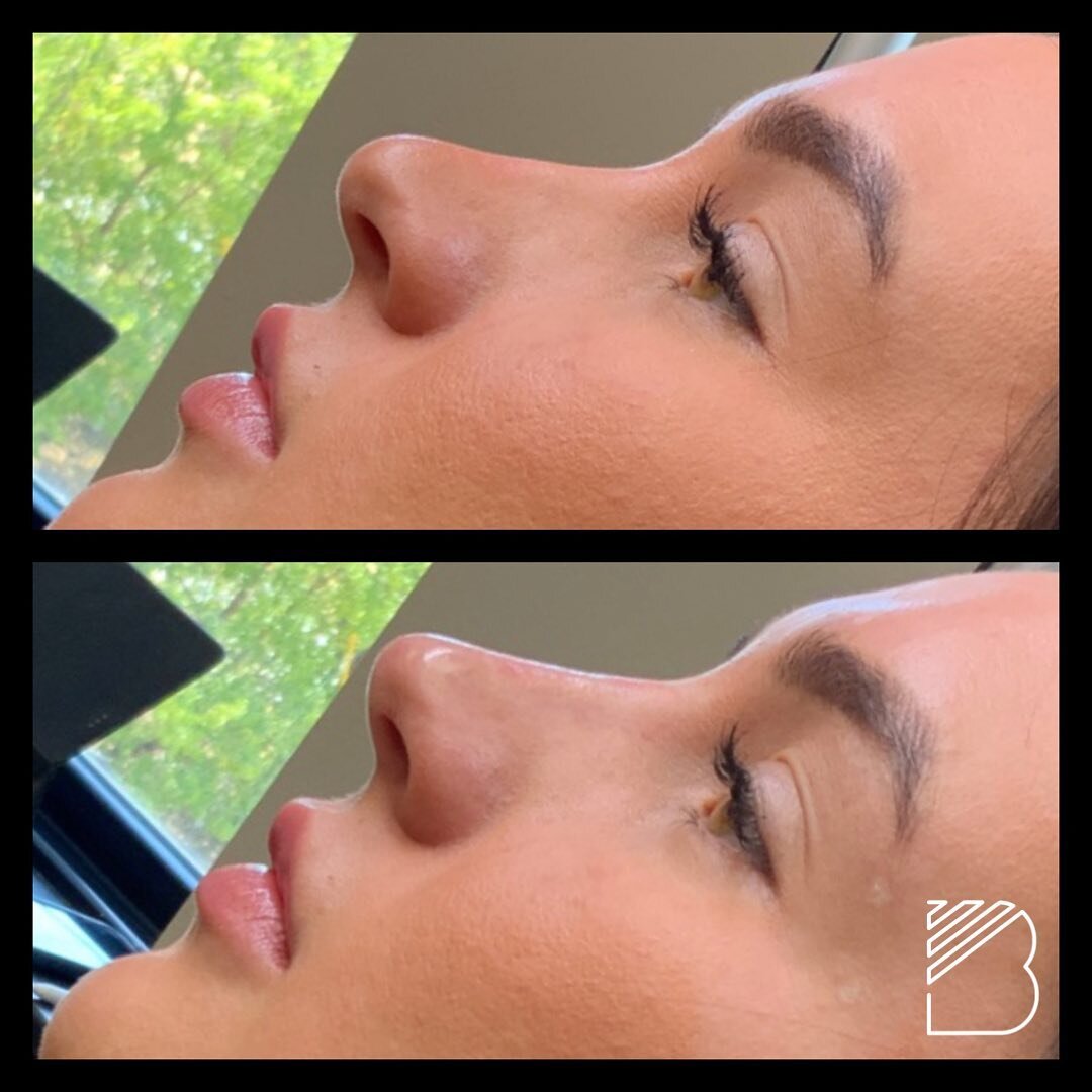 Nonsurgical Nose Job with dermal fillers. She wanted the slight concavity on the left side of the nose corrected as well as the tip more pointed and lifted. #galderma #bougieaesthetics #nsnj #liquidrhinoplasty #dermalfillers #fortworthnosejob #fortwo