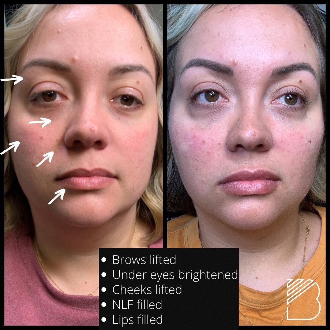 Tear troughs, brows lifted, skin brightened, lateral cheek pop, mid face correction, and lips filled. Clients chief complaint was looking tired, face dropping, and wants to look refreshed.  Multiple products were used&hellip;&hellip;HA Fillers, Radie