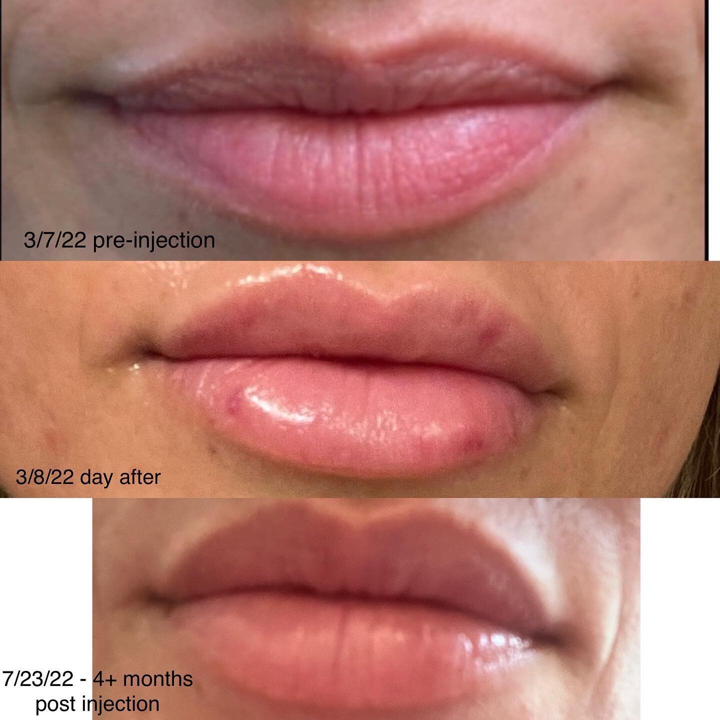 Pre injection, next day, and 4 months after. Client was kind enough to sent me these. #lipfillerbeforeandafter #lipfiller #lipfillerfortworth #lipfillerjourney #npinjector #bougieaesthetics #ａｅｓｔｈｅｔｉｃ #lips #bougielips #restylane #galderma #getyourga