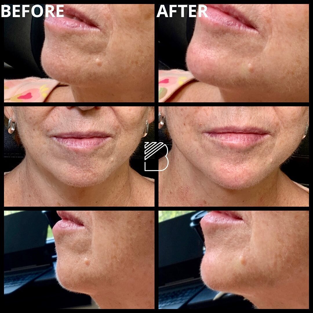Clients concern was recessed chin, cobblestone appearance, and pre-jowl shadowing. #revanesseversa was placed in the subdermal plane for these corrections. Tower technique or Snowman technique was used for projection. This will last around a year. #c