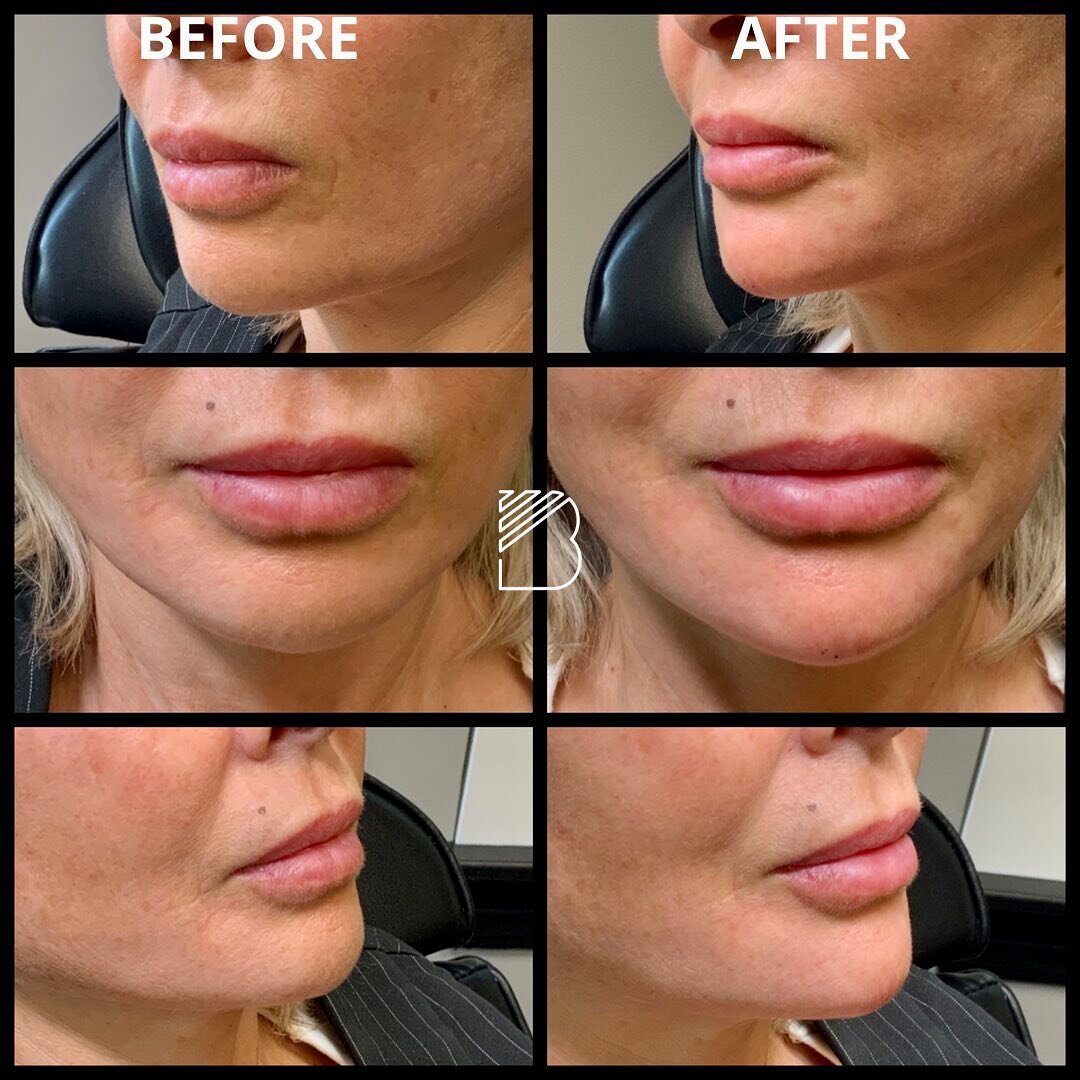 Chin augmentation with 2 syringes of Versa. Cannula and needle technique was used. #bougieaesthetics #chinpop #chinaugmentation #bougiechin #snatchedjawline #jawline #jawlinefiller #dermalfillers #fortworthdermalfillers #dallasdermalfillers #dfwmedsp