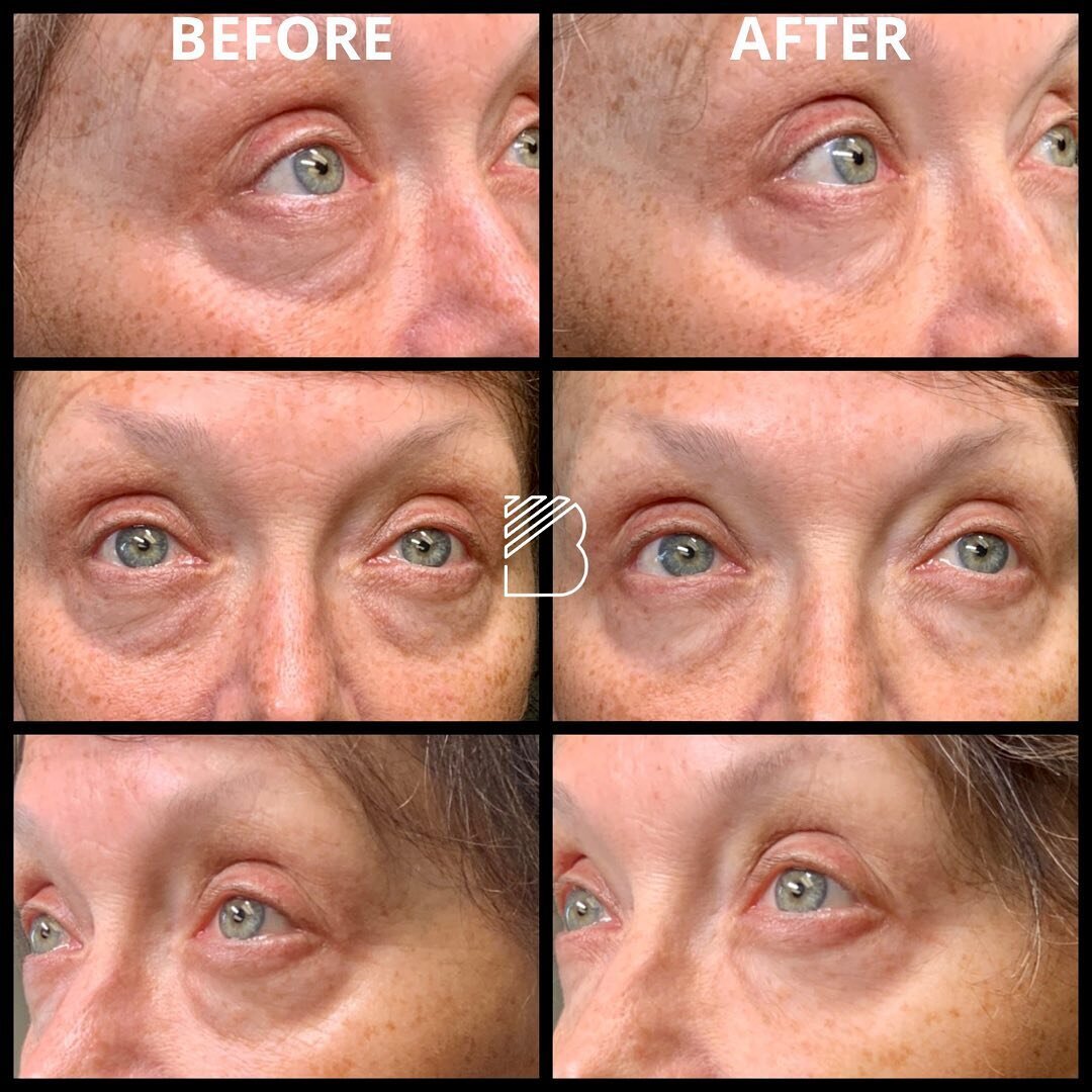 PRFM &amp; Xeomin eye treatment. #beforeandafter #selphyl #prfm #plasmaeyes #prp #xeomin&reg; #merzinstituteofadvancedaesthetics #merzaesthetics #merz #teartrough #eyebags #eyetreatment #fortworth #dallas #dfw #fortworthfillers #dallasfillers