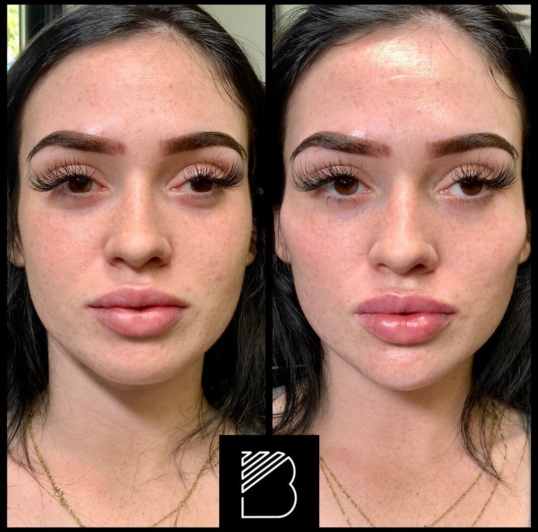 Cheek, chin, &amp; lips. Radiesse was used for the cheeks and she&rsquo;s a little swollen in the photo. Swelling will subside in 3 days. Restylane Lyft was used for the chin and Defyne for the lips. #lipfiller #chinfiller #cheekfiller #radiesse&reg;