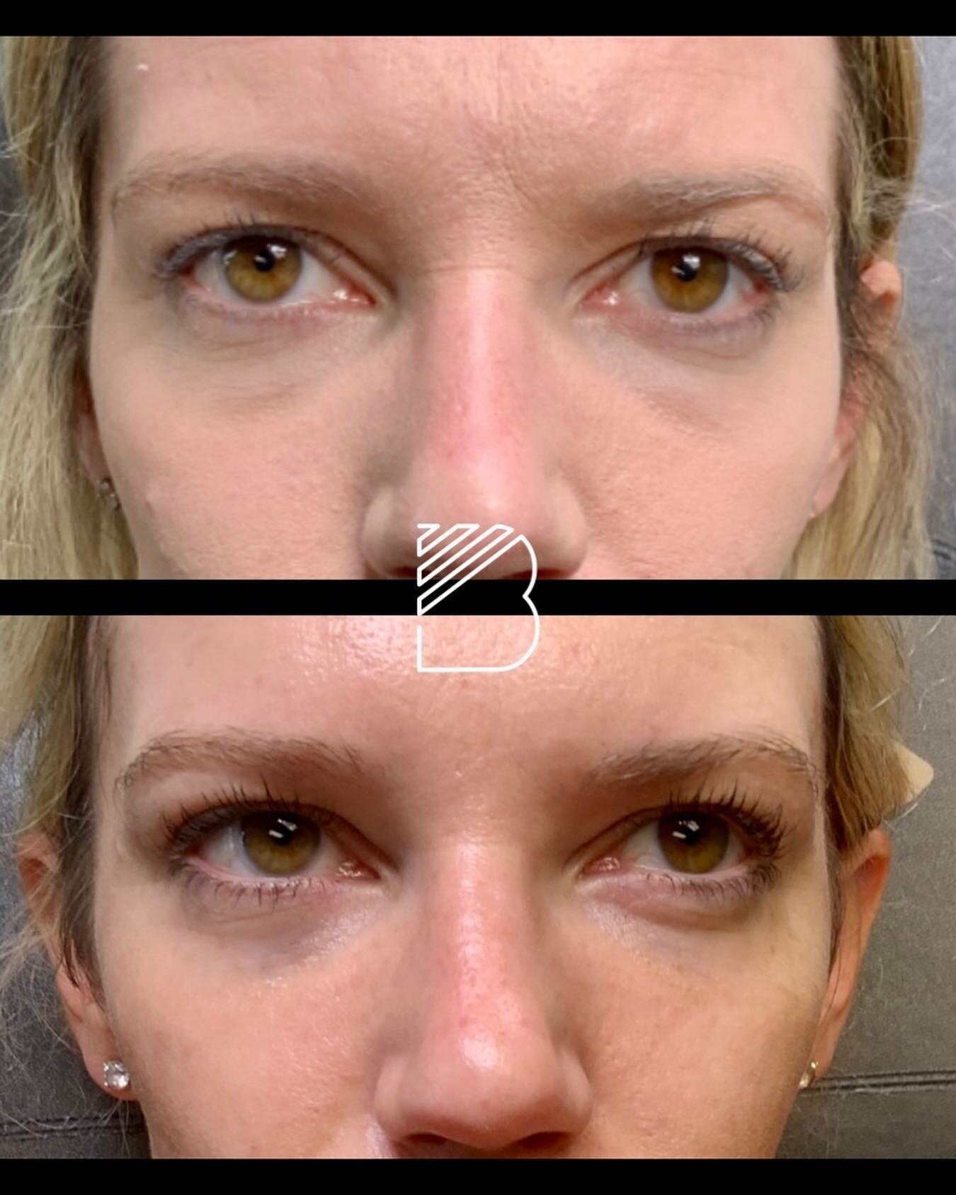 PRFM (Platelet Rich Fibrin Matrix) for under eyes. All natural treatment. Using your own blood as an autologous filler. My recommendation is to do a series of 3 and then do them every six months. Coincides with your Botox injections so it&rsquo;s eas