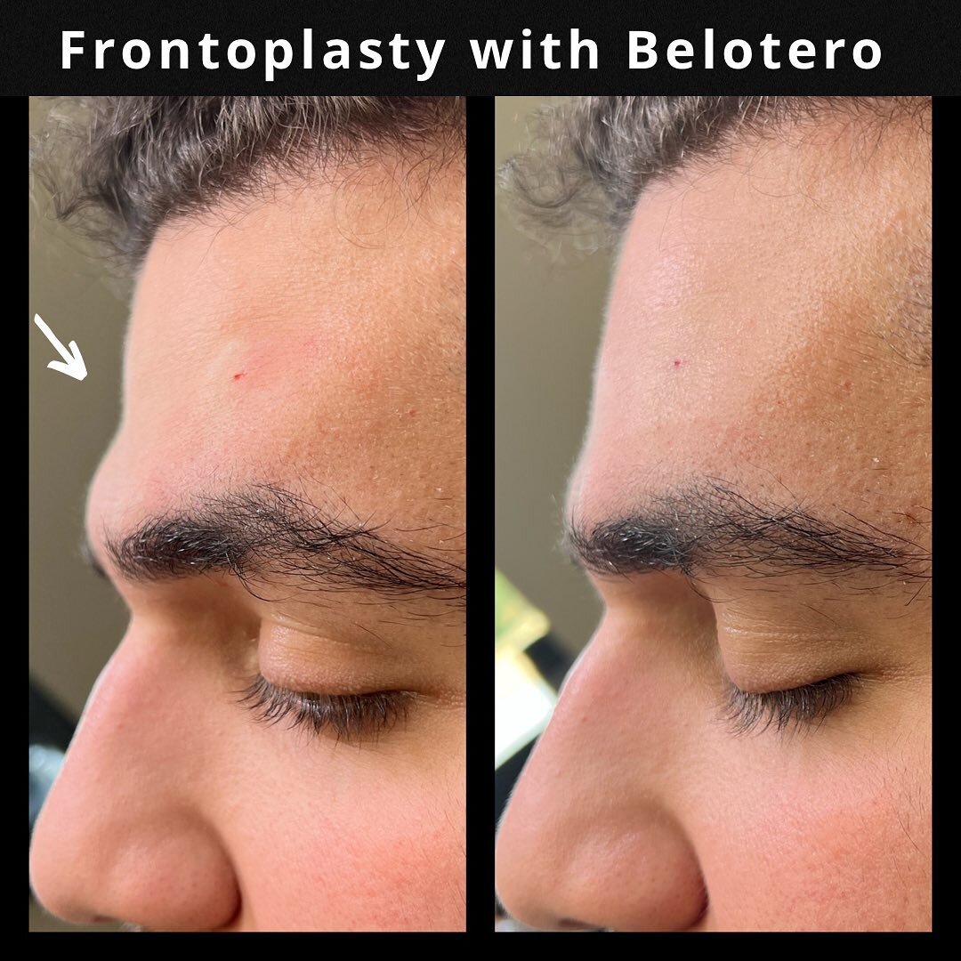 His concern was that he didn&rsquo;t like the concavity of his forehead and wanted a smoother appearance. 
#frontoplasty with #beloterobalance #cannulatechnique used to reassure safety. This is an advanced technique and not recommended for novice inj