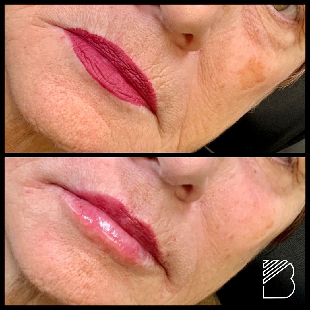 RHA 3 for structural support while being finished off with RHA 2 to soften. Done in two separate sessions. So much joy getting to being life into these lips that have seen 7 decades. #revanceaesthetics #bougieaesthetics #lipfiller #lipfillerbeforeand