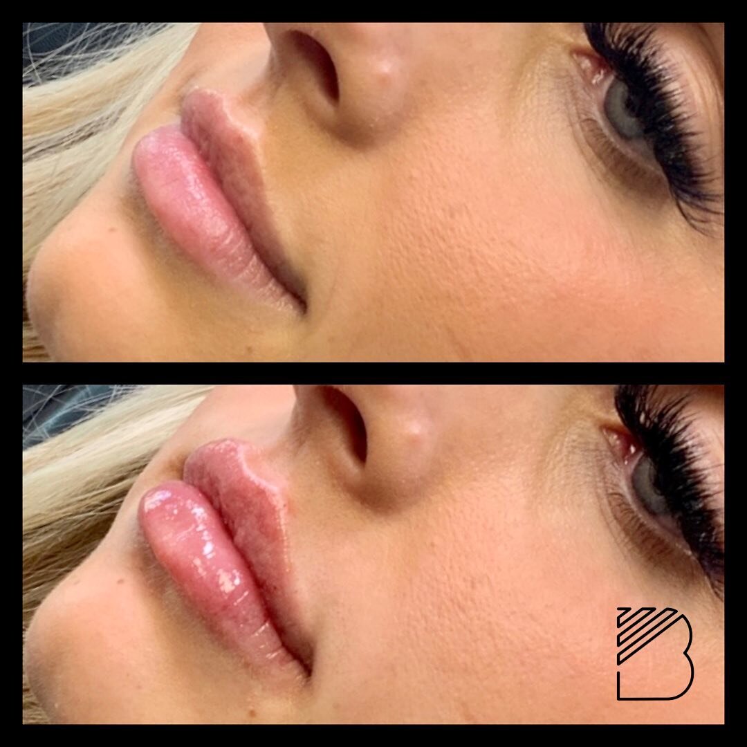 1/2 syringe yearly touch up for this beauty. She&rsquo;s been with me for over 3 years now and look how natural her lips still look. We&rsquo;ve been using dermal fillers in the @galderma family since year one. I can&rsquo;t stress enough how importa