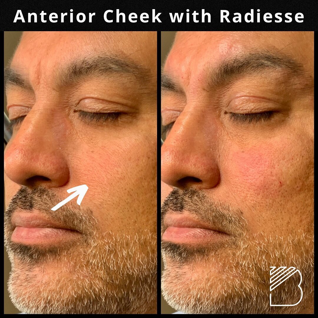 Male Mid Face correction with #radiesse #fortworth #fortworthtx #fortworthmedspa #merzinstituteofadvancedaesthetics #merz #merzaesthetics #menoffortworth #menofdallas #dfwmen #dermalfillersformen #mentreatment