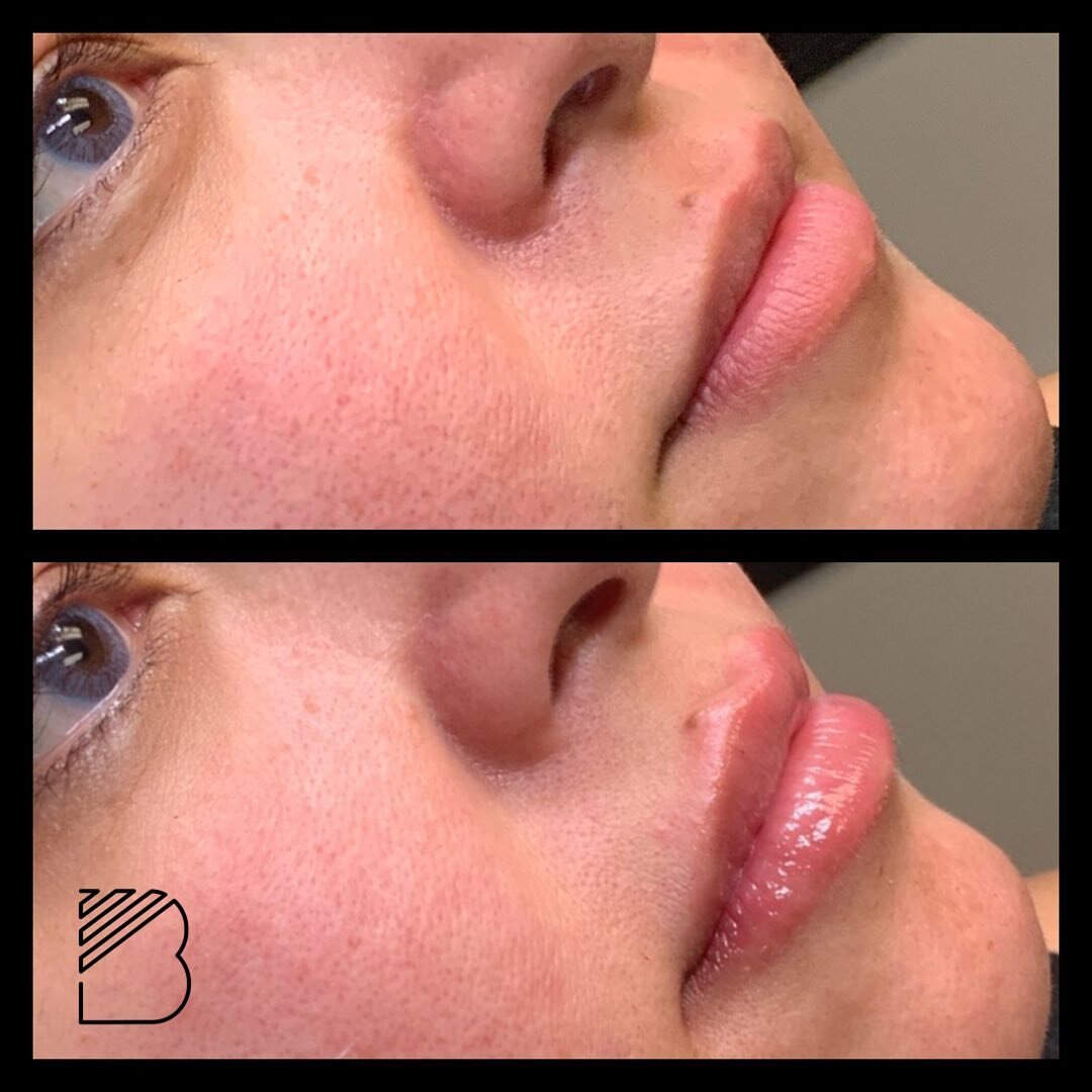 Full syringe of UltraXC. Ultra XC is FDA approved for the lips and provides a soft natural appearance. #juvadermlips #juvaderm #allergan #bougieaesthetics #ａｅｓｔｈｅｔｉｃ #fortworthlipfiller #fortworthlips #dfwmedspa #fortworthmedspa #dallasmedspa